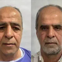 عمل پلک (افتادگی پلک)لیزری بصورت تضمینی