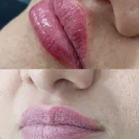 تزریق چربی ژل فیلر نخ بوتاکس