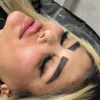 آموزش و تزریق تخصصی ژل و بوتاکس