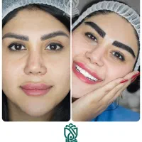 کاشت ابرو بدون جراحی با شرایط ویژه و اقساطی