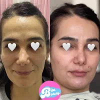 آفر ویژه ژل و بوتاکس برای مدت محدود در کلینیک
