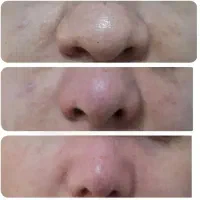 کوچک کردن بینی بدون جراحی