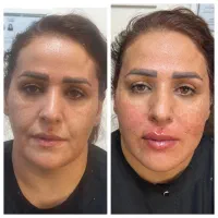 لیفت صورت و ابرو تزریق فیلر ‌بوتاکس با قیمت مناسب