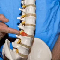 رفع دیسک و بیرون زدگی مهره ها و سیاتیک