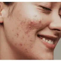 رفع تضمینی  جوش صورت