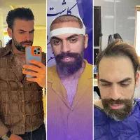 کاشت مو ابرو مزو و پی آر پی بوتاکس