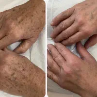 آموزش حذف کک و مک با یک جلسه