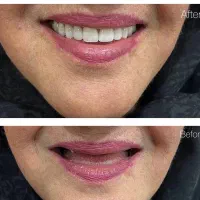 دندان مصنوعی ژله ای