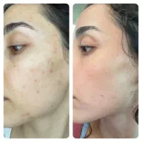 کر.‌م بیو‌، ممتیک جوش و ضد لک