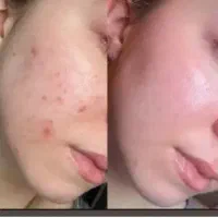 کرم ترمیم کننده رفع جای زخم، و جوش و بخیه