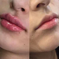 تزریق ژل و بوتاکس و مزو از ۸۰۰تومن