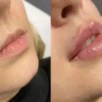 ژل و بوتاکس