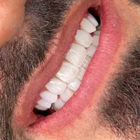 کامپوزیت دندان و خدمات زیبایی
