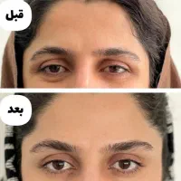 بوتاکس با 50 درصد تخفیف به صورت حرفه ای