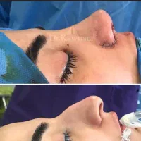 عمل زیبایی بینی دم قسط