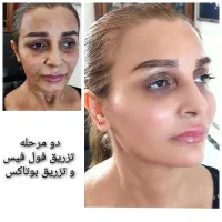 جشنواره تزریق ژل فول فیس و بوتاکس