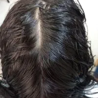 محلول گیاهی پاکسازی شپش و رشک تضمینی