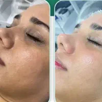 پاکسازی و فیشیال و لیزر