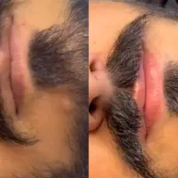 رفع تیرگی لب،شیدینگ کاموفلاژ بدن اسکالپ سر آقایان