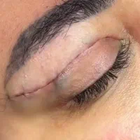 بلفاروپلاستی 5تومن با بخیه ظریف وبدون اسکار