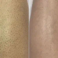 لیزر شاتی با ضمانت برگشت وجه