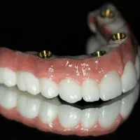 دندانپزشکی اوردنچر دو فک فقط ۱۲۴ تومن درتبریز