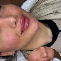 آف و خدمات همه لاین ها آموزش و خدمات ژل بوتاکس
