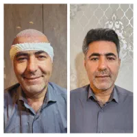 کاشت مو باشرایطی که نباید ازدست بدی