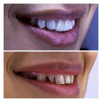 تخفیف ویژه ی کامپوزیت زیبایی