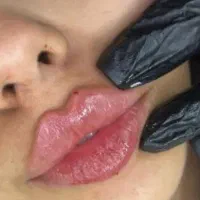 تزریق ژل صورت و بدن بدون درد و کبودی