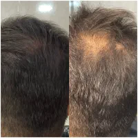 خدا حافظی با کم حجمی مو وطاسی سر