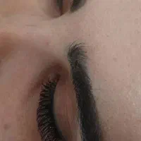 کاشت هیدن 200 تومن تخفیف تا فردا