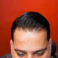 تخصصی ترین مجموعه پروتز مو در تهران ( نقد و اقساط)