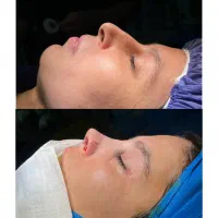 جراحی بینی باتخفیف ویژه جشنواره