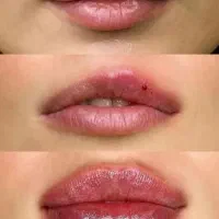 فیلر ژل بوتاکس لاغری چربی ساکشن پیکرتراشی لیزر