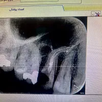 عصب کشی تخصصی  بدون درد در ونک
