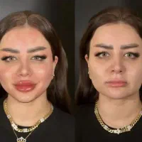 خدمات ژل وبوتاکس