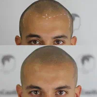 کاشت مو و ابرو با شرایط اقساط