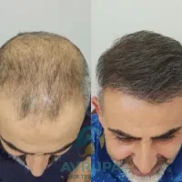 اگه میخوای کچل نشی پیام بده