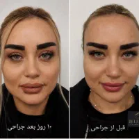 بلفاروپلاستی پلک بابخیه لیزری/سانترال لب/کاشت ابرو