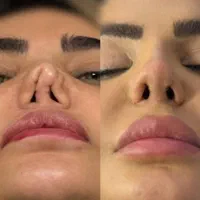 عمل بینی قسطی فقط با ماهی ۵م