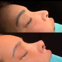 انواع عمل زیبایی در بیمارستان بینی.غبغب.بلفارو.ژل