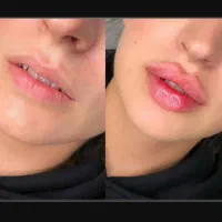 ژل لب|خدمات زیبایی و سلامت|تهران, تهرانسر شرقی|دیوار