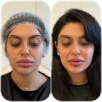 زاویه سازی صورت و فرم دهی طبیعی تخصصی