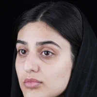 عمل بینی حرفه‌ای با تکنیک روز دنیا /شیراز/اقساط