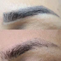 رفع تاتو و خالکوبی و تیرگی با لیزر