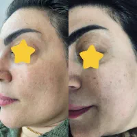 لیزر|خدمات آرایشگری و زیبایی|همدان, |دیوار
