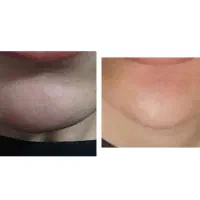 بوتاکس زیر بغل