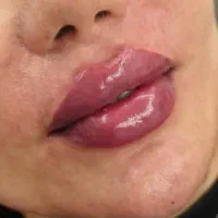 نیازمند مدل ژل و بوتاکس