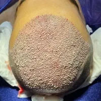 کاشت مو و ابرو میکرو کاشت (رایگان)|خدمات زیبایی و سلامت|تهران, مرزداران|دیوار